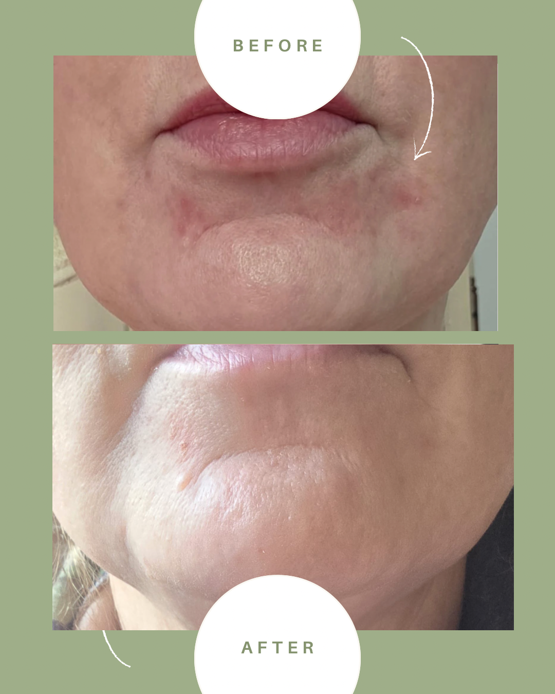 Before and after peri oral dermatitis 